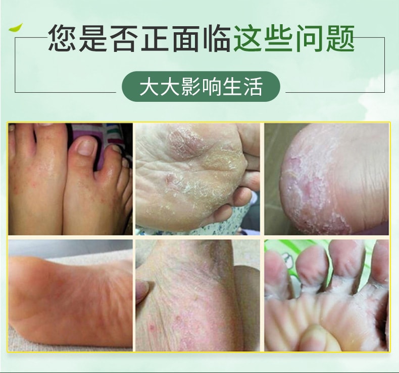 【中国直邮】足康净抑菌粉 100g 