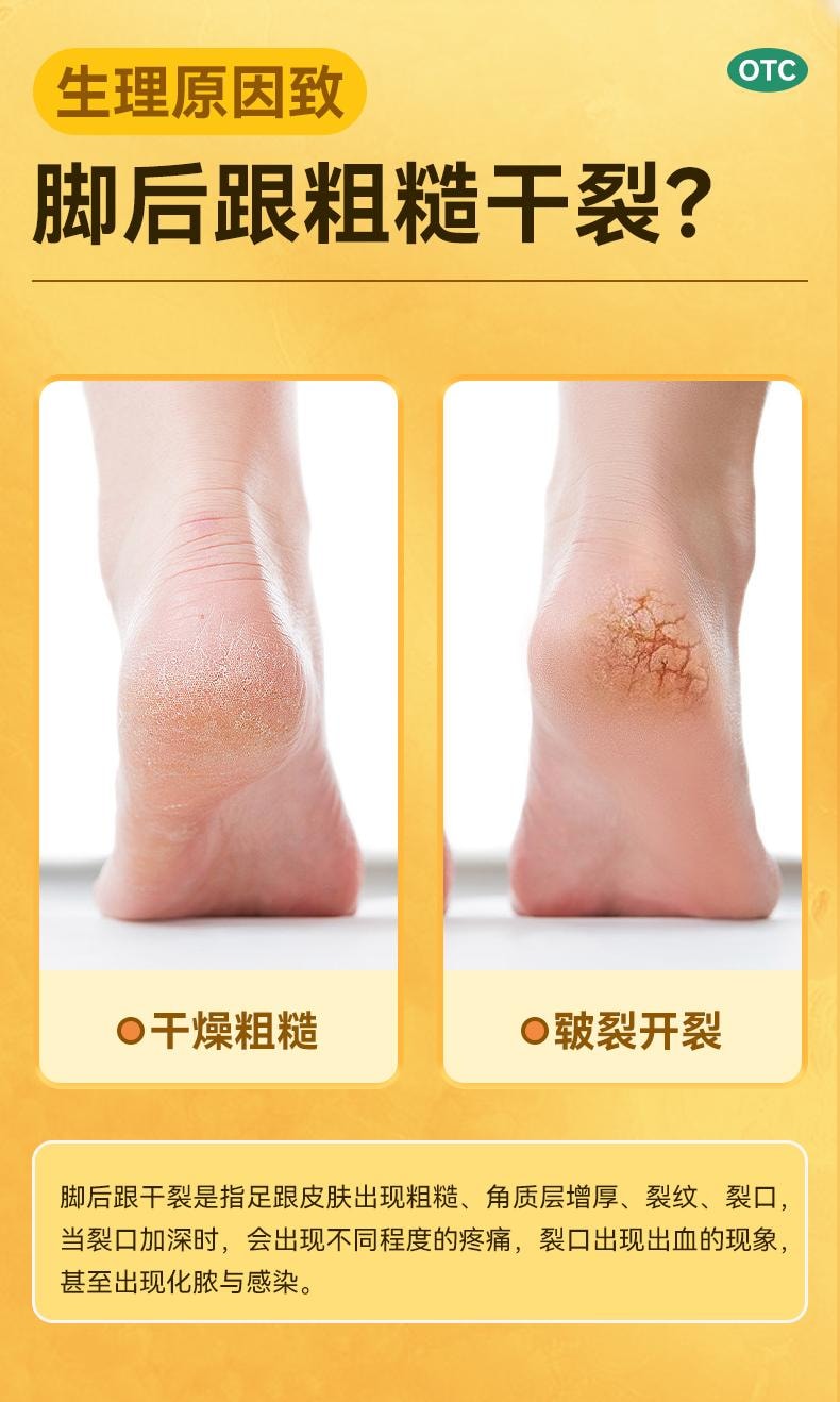 【中国直邮】 快比宁 尿素乳膏 脚后跟干裂修复霜 起硬皮足跟开裂专治 脚裂膏角化型湿疹药 10g/盒