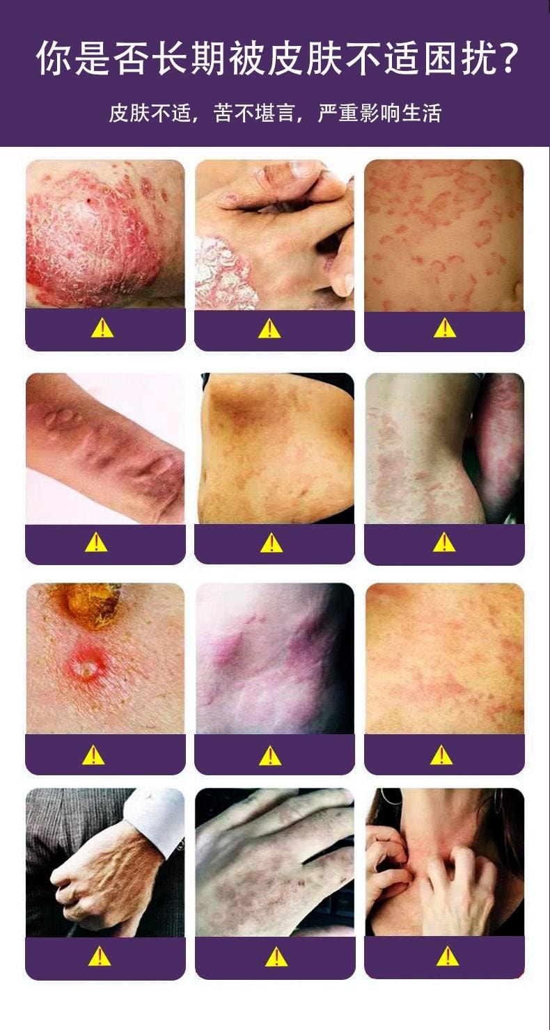 【中國直郵】 姚本仁 苗鋪膚癢靈 皮膚搔癢濕癢止癢外用軟膏乳膏 20g/盒