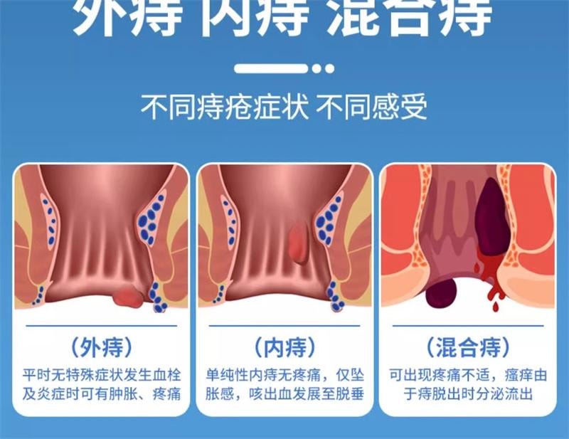 美国 仁和 消痔凝胶 痔疮膏内外痣疮舒肉肛球周瘙痒舒痔型卡波姆敷料  5支/盒
