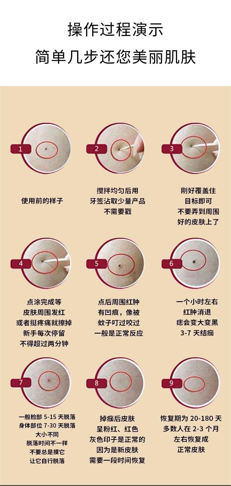 香港同济大药房 点痣膏5g/盒 肉刺脂肪植物萃取黑痣痦子瘊子点疣膏