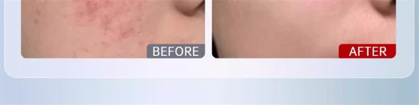 【中国直邮】 质润 壬二酸精华15% 祛痘凝胶祛痘印修复淡化痘印面霜 15g/盒