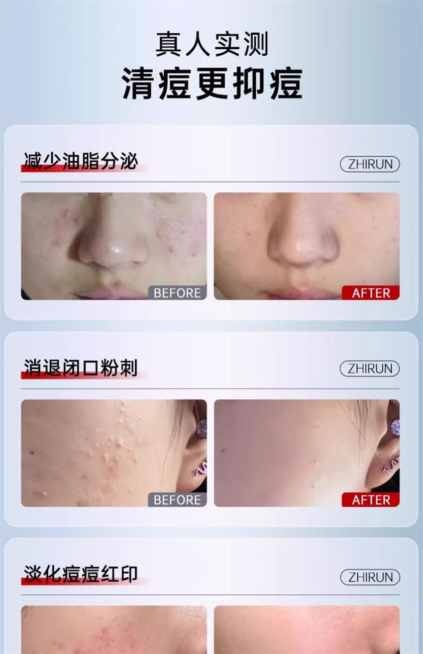 【中国直邮】 质润 壬二酸精华15% 祛痘凝胶祛痘印修复淡化痘印面霜 15g/盒