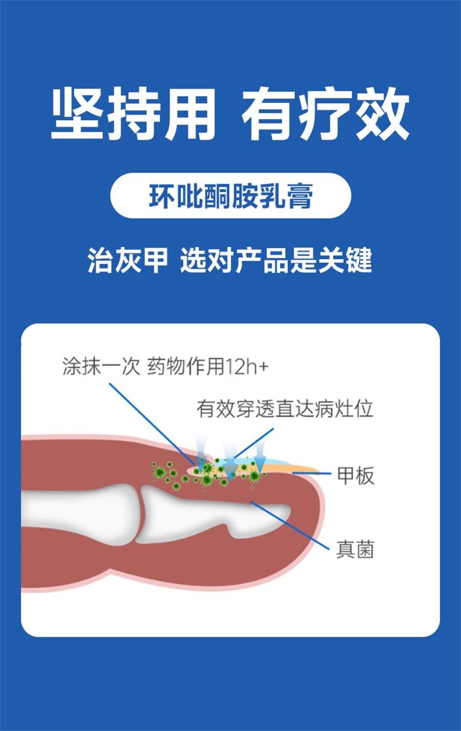  恒医森 灰指甲用药环吡酮胺乳膏治疗灰指甲甲癣脚气股癣花斑癣   20g/支