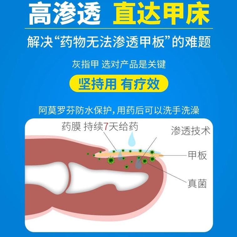 【中国直邮】  祥医堂 阿莫灰甲抑菌擦剂 修复灰指甲脱甲液 阿莫罗芬搽剂灰指甲正品 5ml/盒