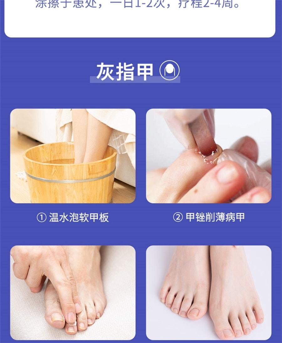【中国直邮】  双吉 环吡酮胺乳膏 脚气药膏灰指甲用药阿莫罗芬搽剂 20g/盒【医师推荐拍3盒】