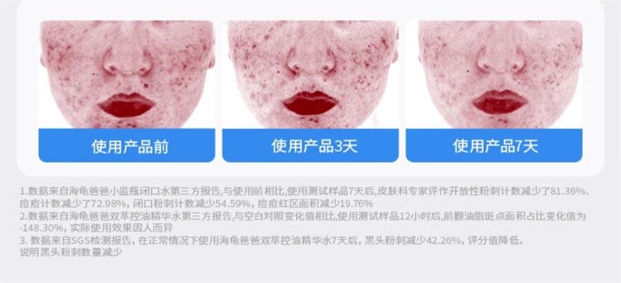 【中国直邮】 海龟爸爸 闭口水青少年控油抗痘爽肤水收缩毛孔精华水女孩湿敷水 150ml/瓶