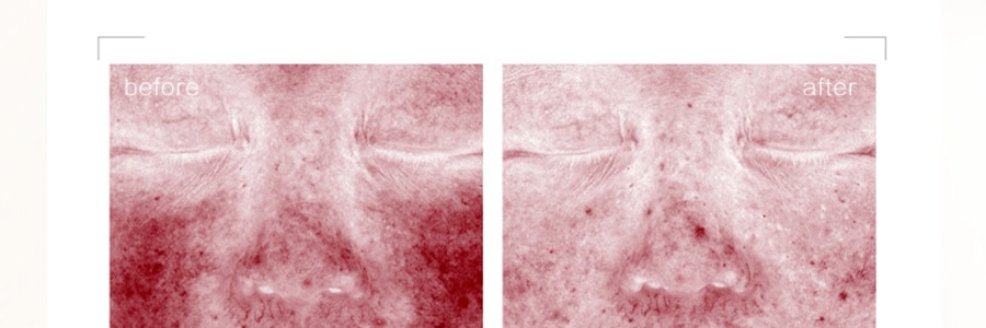 CHANDO自然堂 III型重组胶原蛋白修护冻干面膜 5片入 直击干敏垮脸