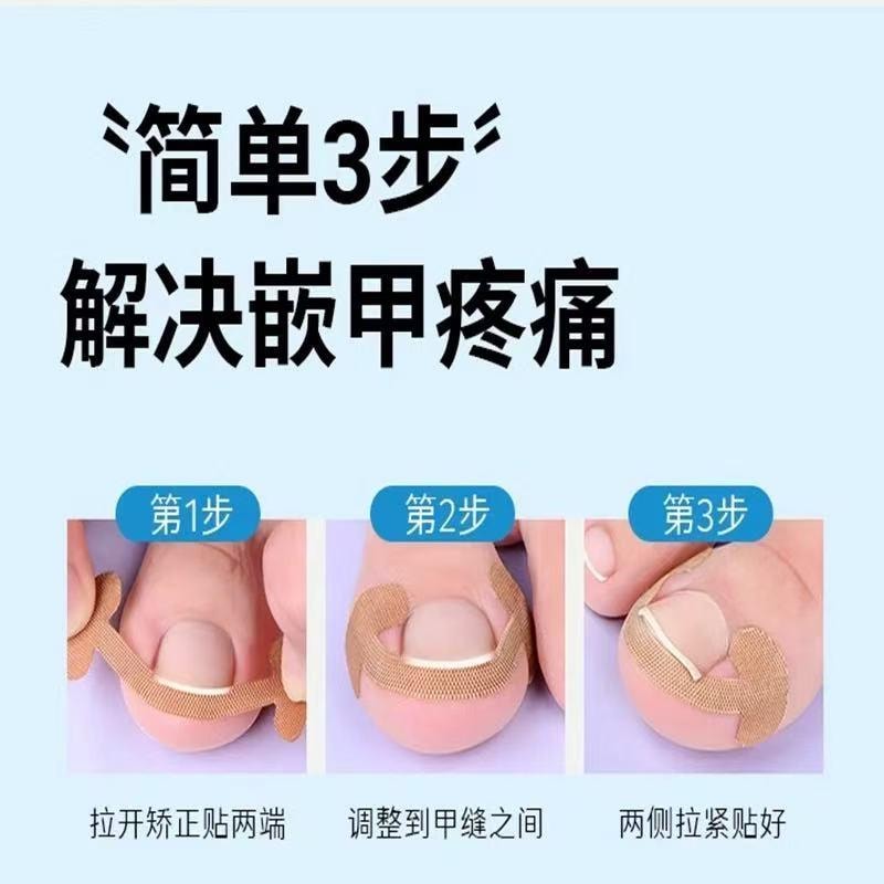 爱神严选 甲沟矫正器一套【嵌甲贴20贴+垫片20根】 专治甲沟炎嵌甲贴片 脚趾甲往肉里长专用隔离填充垫 正甲工具神器