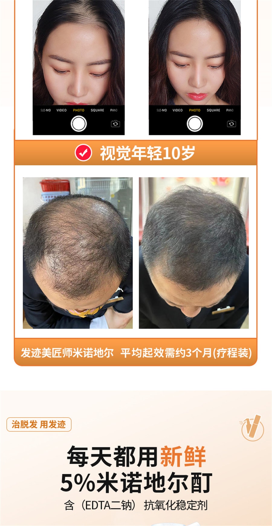 【中国直邮】发迹 米诺地尔酊生发液正品5%男女性町米洛若丁地尓原液  5%*90ml/盒