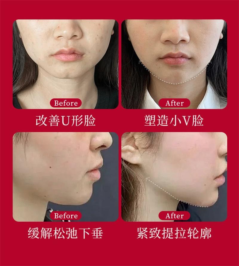 韩伦美羽 红蜜提拉紧致胶原面膜 脸部挂耳式贴片双下巴V脸瘦脸神器 5片/盒