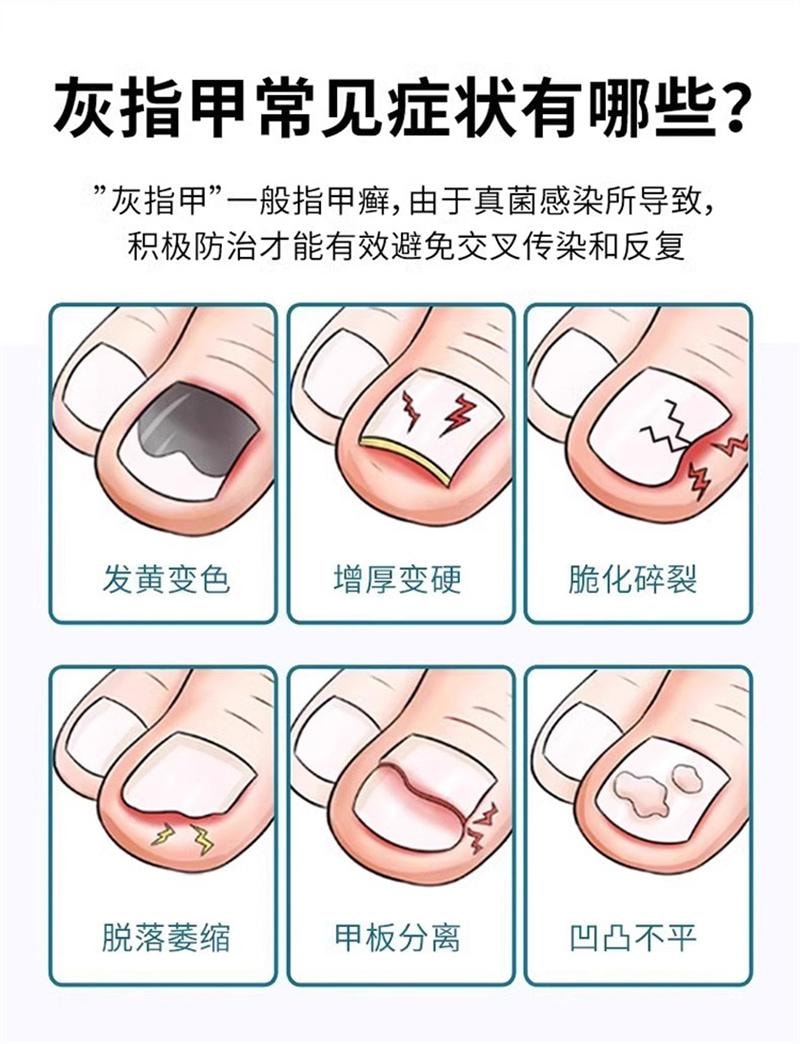  仁和 环吡酮胺乳膏10g灰指甲治疗专用药膏水正品真菌感染脚气药