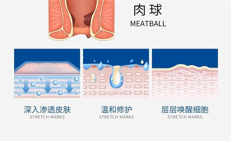 【中国直邮】 丁达尔 医用卡波姆痔疮敷料 痔疮膏 舒肿缓痛 散热解表 用于内球外型混合型 20g/盒