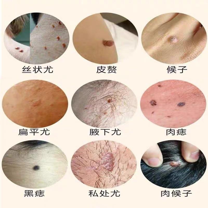  祥醫堂 絲狀扁平疣克尤刺瘊脖長小肉粒外用藥膏 5%咪喹莫特乳膏20g