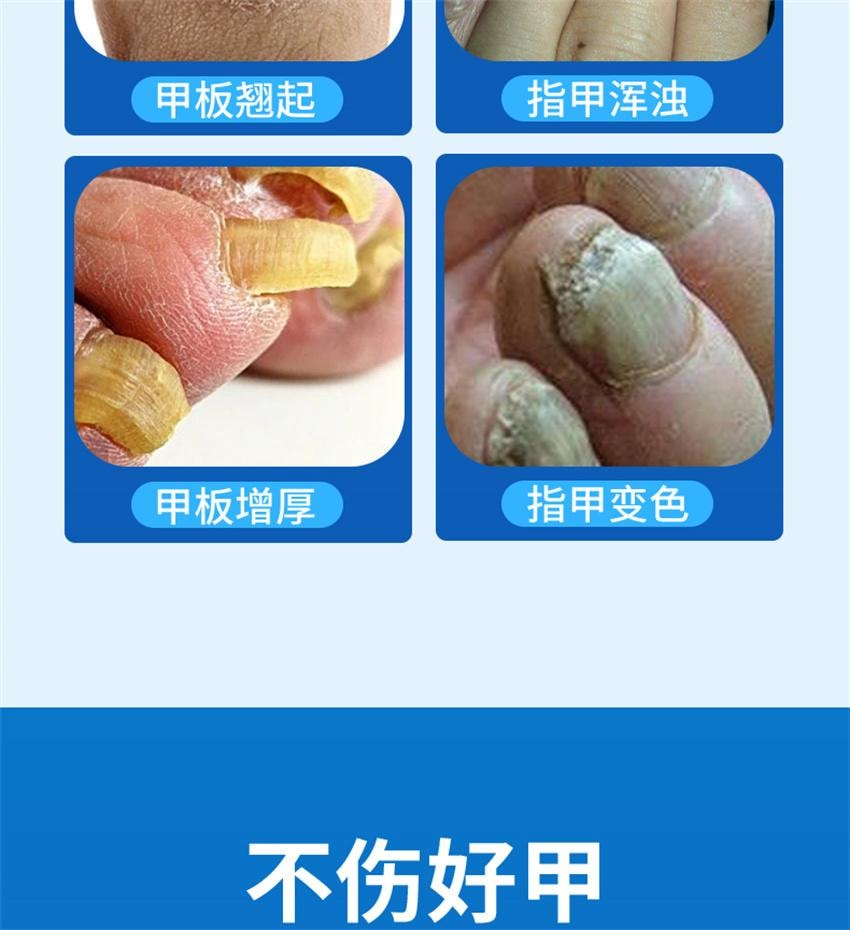 【中国直邮】 祥医堂 阿莫灰甲抑菌擦剂 修复灰指甲脱甲液 阿莫罗芬搽剂灰指甲正品 5ml/盒