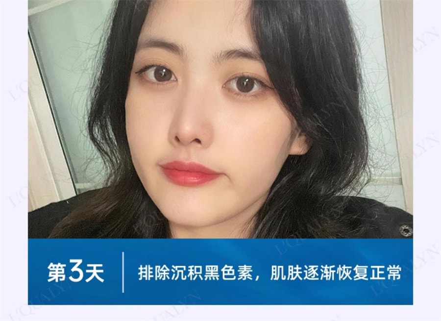 【中国直邮】欧泉琳 点痣膏无痕脸部去痣淡斑神器点痣笔非药水点斑美容专用 5g/瓶+5ml/瓶