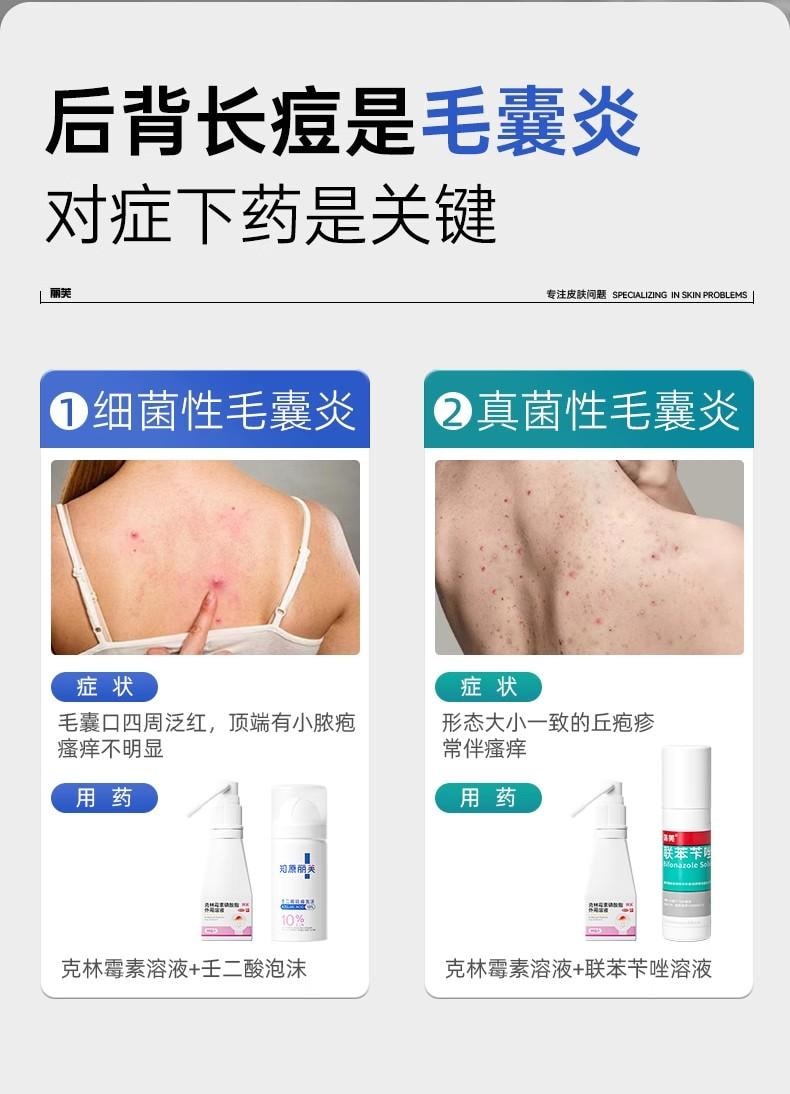 【中国直邮】 丽芙 外用溶液 毛囊炎前胸后背祛痘喷雾背部祛痘除螨 30ml/瓶