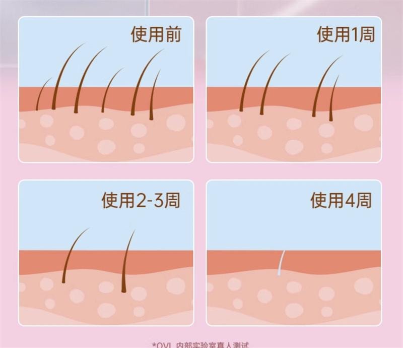 【中國直郵】 ovl 冰點除毛儀家用永久女私密腋下全身醫用雷射剃毛器 微光綠-3倍冰點pro 1個裝