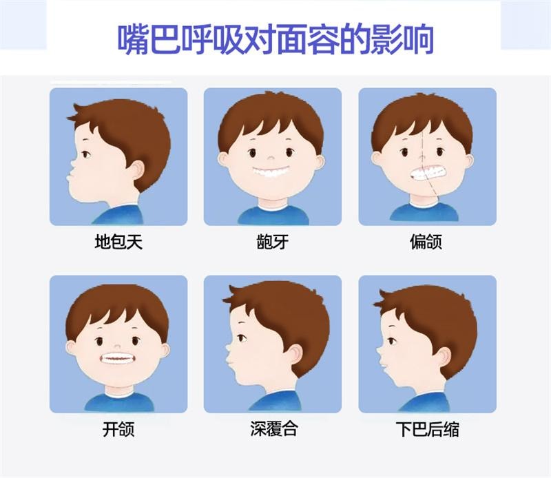  小鹿媽媽 閉嘴貼呼吸調整貼呼吸防張嘴貼睡覺閉合兒童 30片/盒