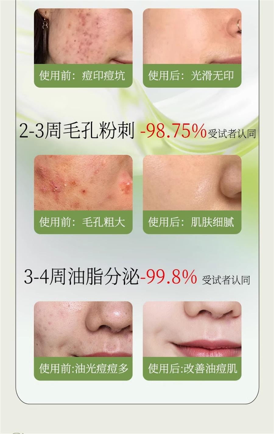Herbal acne Cream Face for teenagers Repair anti-inflammatory acne Mark pit scar and pimple 20g/ bottle