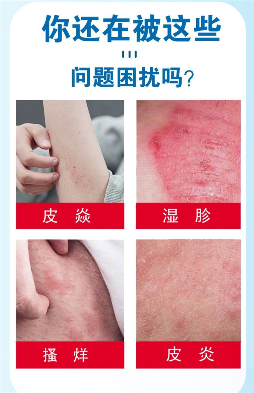 【中国直邮】 祥医堂 地奈德乳膏 适用于神经性皮炎 湿疹 皮肤瘙痒药膏 15g/盒(医师推荐拍3盒)