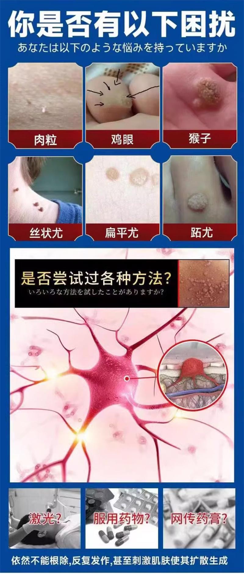 祥医堂 鬼臼毒素酊10ml/盒 去鸡眼尖锐丝状扁平克疣抑菌外用