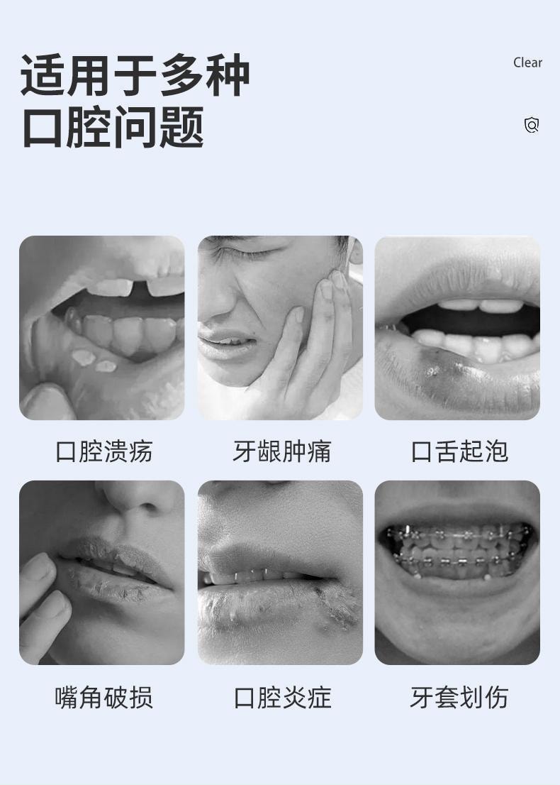 【中国直邮】 易复美 口腔溃疡凝胶 隔绝侵蚀 减轻疼痛 缓解疼痛保护创面 20g/支