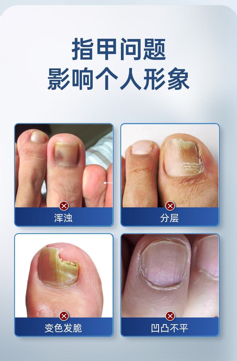 【中国直邮】 易复美 冰醋酸溶液涂剂 泡脚灰甲抗抑菌指甲专用冰乙酸稀释 100ml/瓶