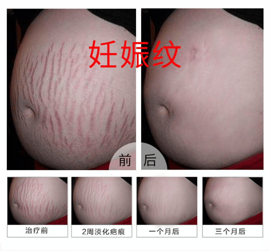 Medical Silicone Gel Dressing For Surgical Bump Removal 20g/Pc