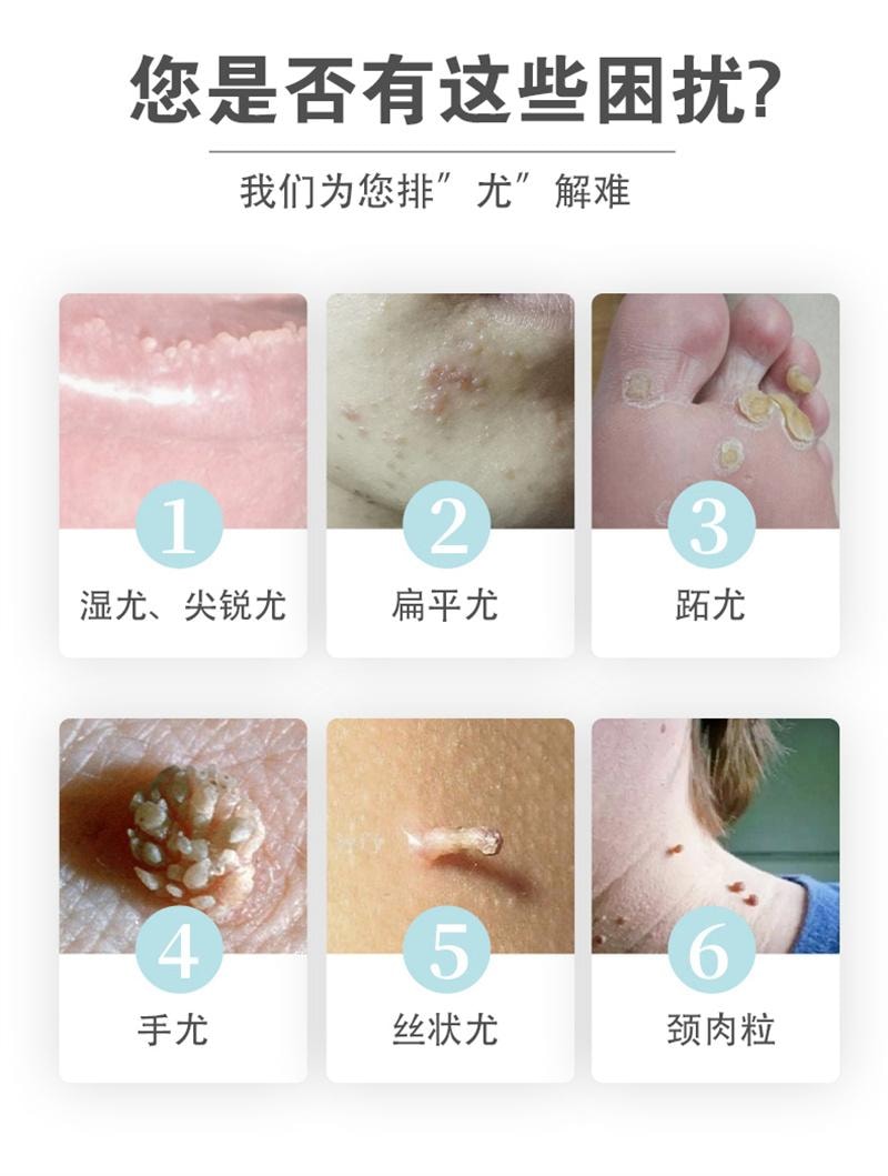  祥医堂 脖子肉粒丝状扁平疣去疣不留根 嘧腚抑菌克疣膏20g