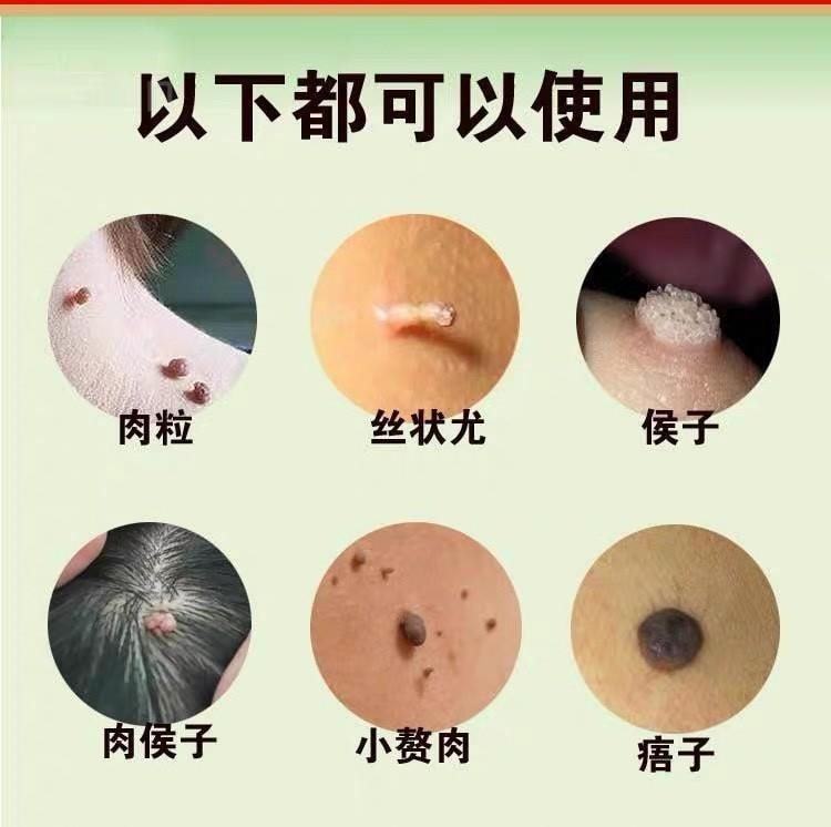  祥醫堂 絲狀扁平疣克尤刺瘊脖長小肉粒外用藥膏 5%咪喹莫特乳膏20g