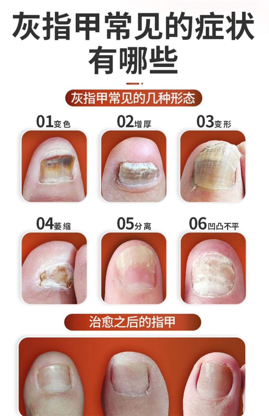 【中國直郵】亮甲 複方聚維酮碘搽劑 灰指甲專用藥去甲癬治療指甲藥殺滅真菌 3ml/瓶 | 亞米