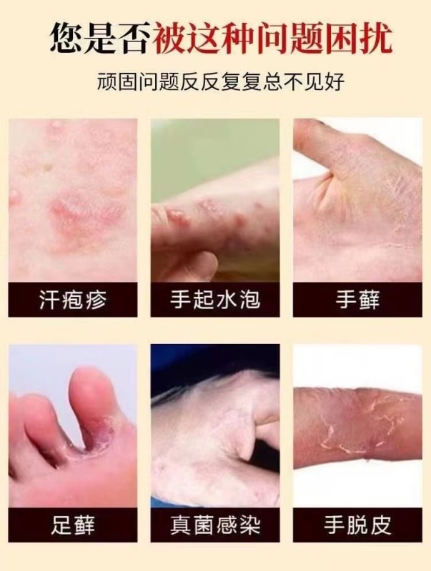 【中國直郵】 嚴和 汗疹草本乳膏 小水泡手癢皮膚搔癢蚊蟲叮咬抑菌止癢膏 15g/盒