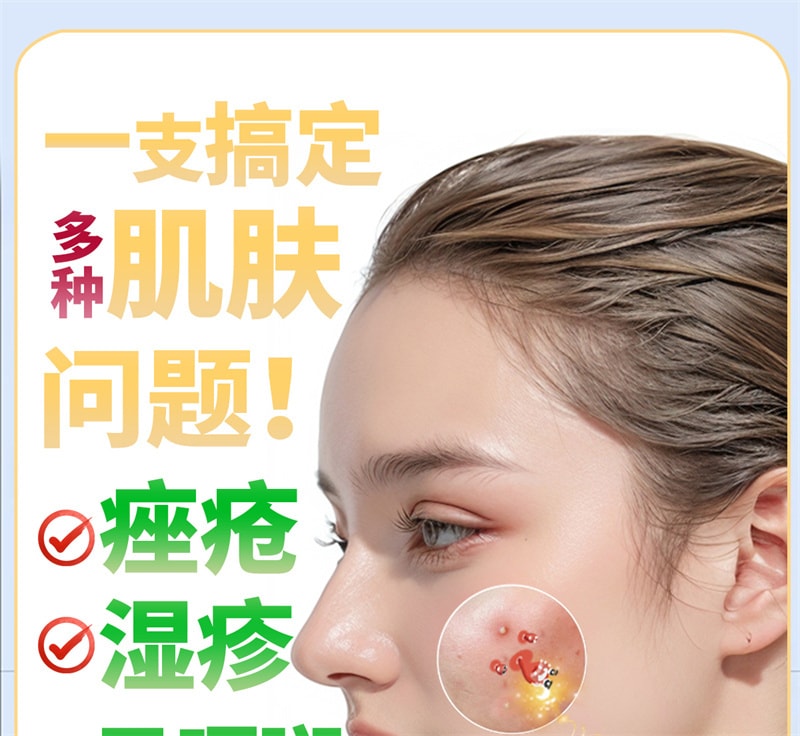 【中国直邮】 良济 玫芦消痤膏 祛痘药膏 用于痤疮痘印湿疹青春痘皮肤瘙痒日晒疮 15g/盒