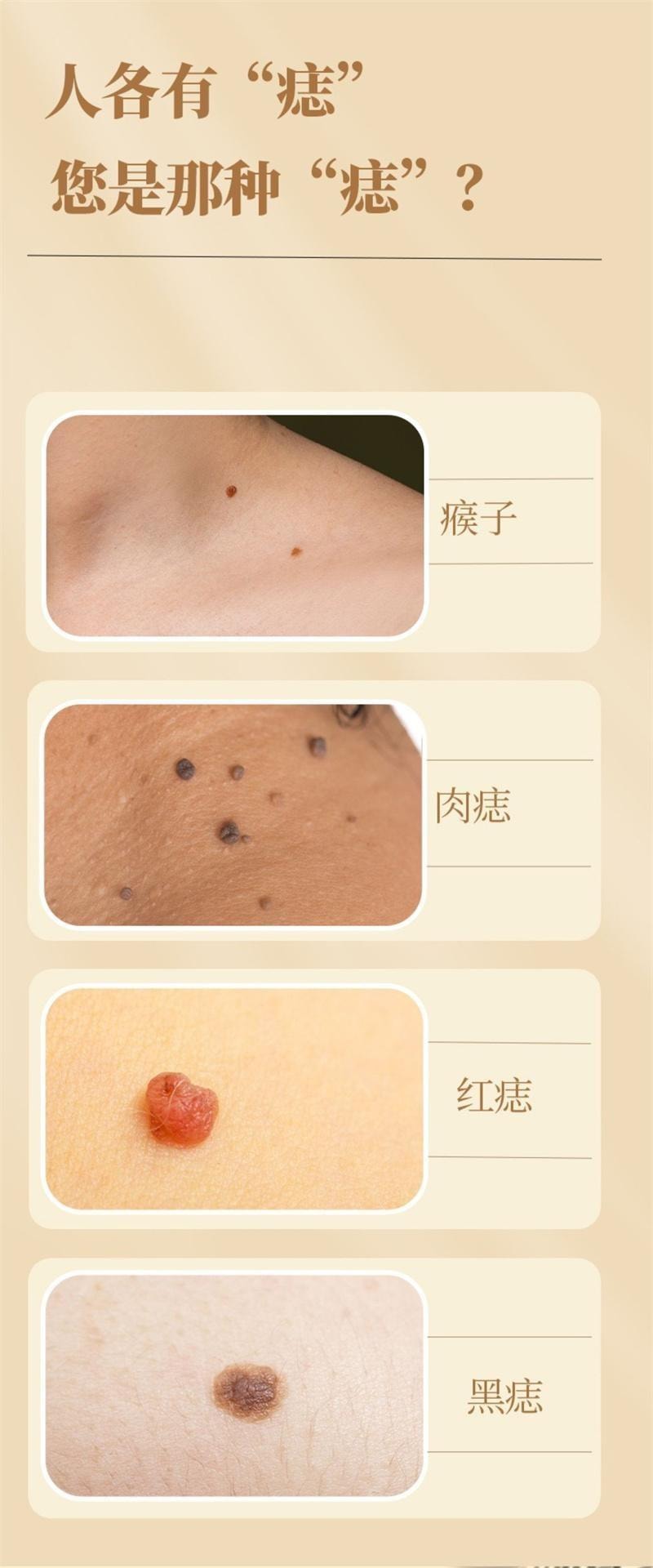 香港同济大药房 点痣膏5g/盒 肉刺脂肪植物萃取黑痣痦子瘊子点疣膏