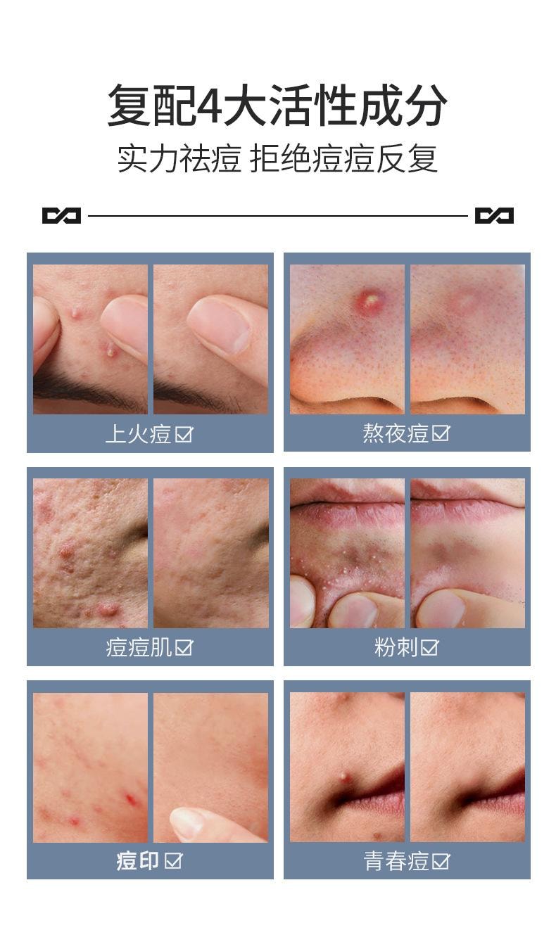 【中国直邮】 左颜右色 补水面霜控油 不粘腻祛痘 凝胶男女通用祛痘膏10g