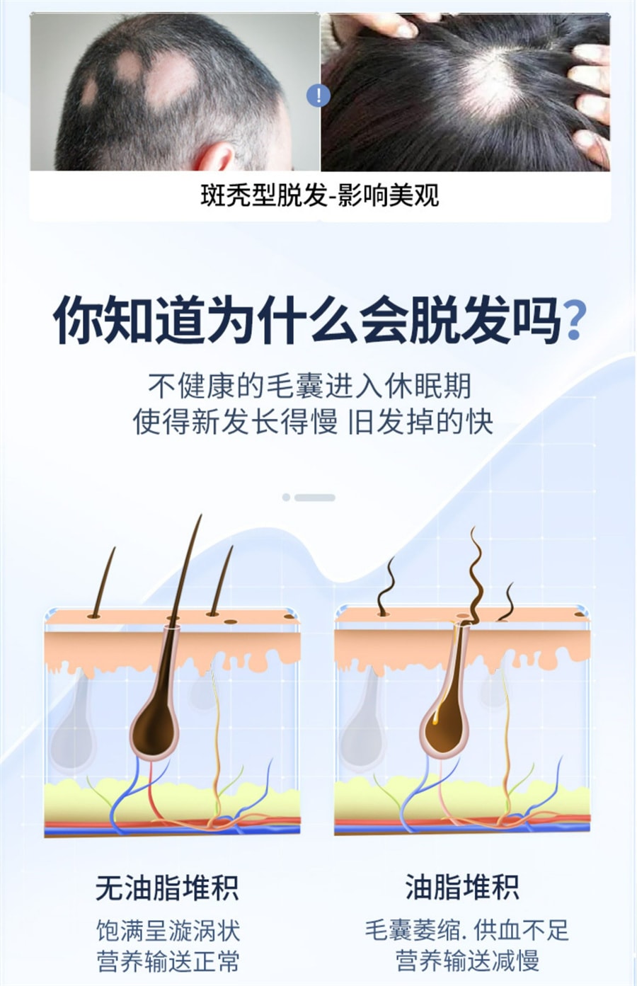 【中国直邮】 达霏欣 米诺地尔搽剂男女性脂溢性脱发生发液上药器  5%*60ml/盒男士