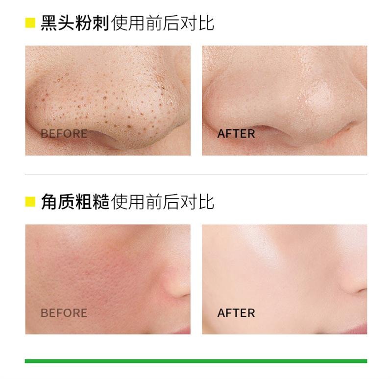 韩伦美羽 水杨酸棉片 祛痘痘印黑头去闭口粉刺清洁收缩毛孔湿敷棉片 柔和型 55片/盒