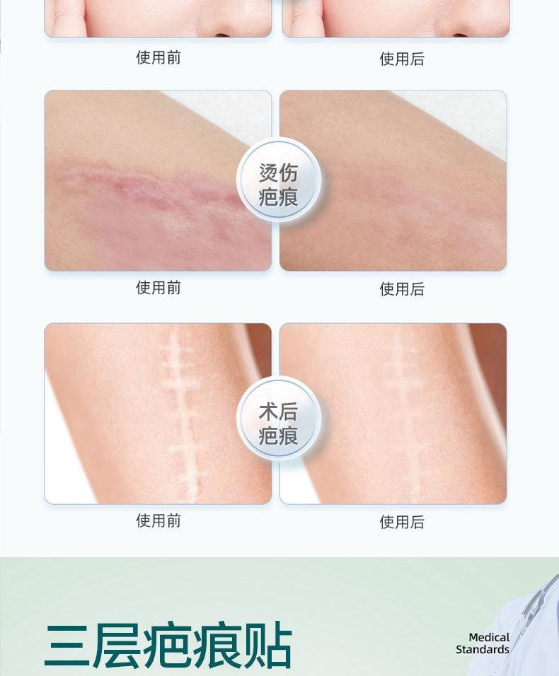 【中国直邮】 舒奈美 疤痕贴抑制疤痕增生贴疤刨腹疤痕隐形贴卷硅凝胶疤痕修复贴 (卷装)