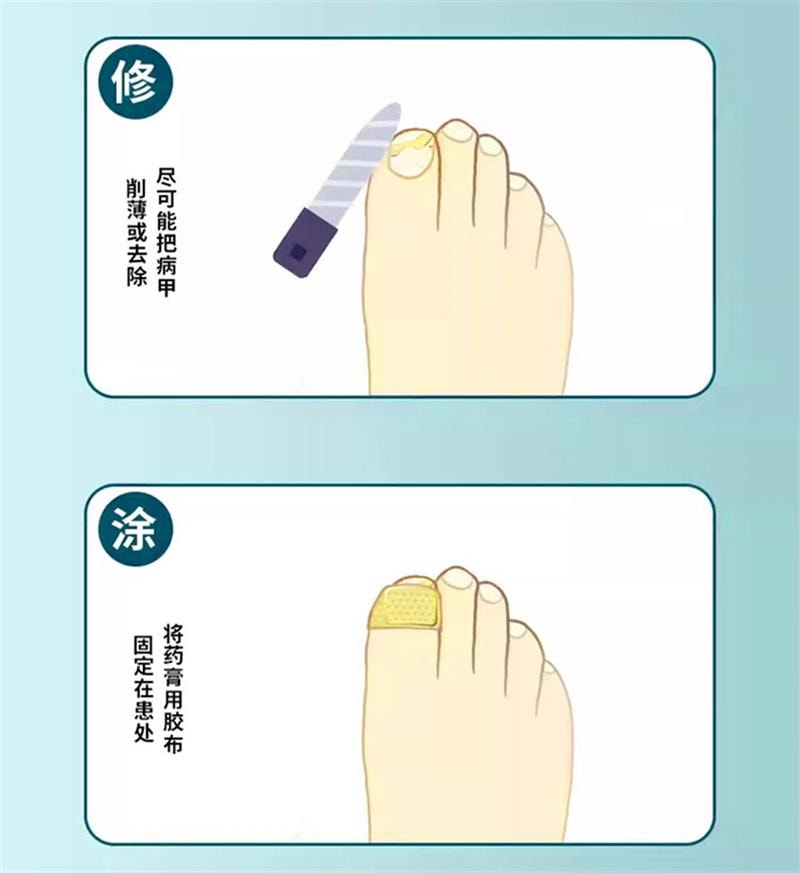  仁和 环吡酮胺乳膏10g灰指甲治疗专用药膏水正品真菌感染脚气药