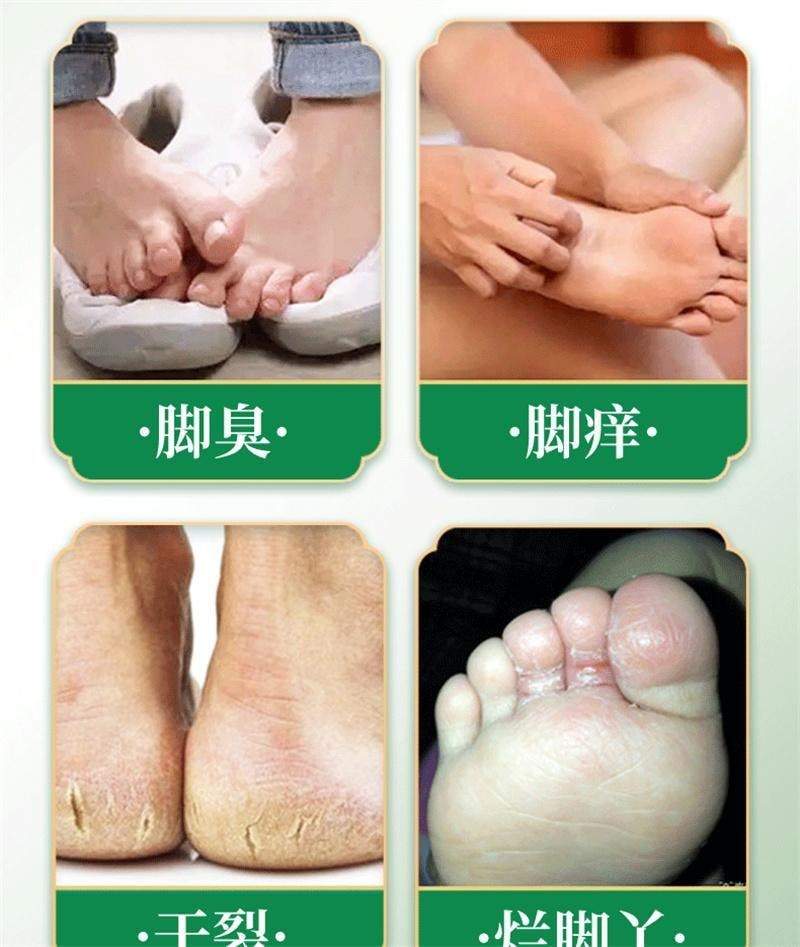 【中国直邮】 祥医堂 联苯苄唑喷雾 脚气喷雾 脚臭脚痒抑菌止痒抑菌液 60ml/盒(脚气克星)