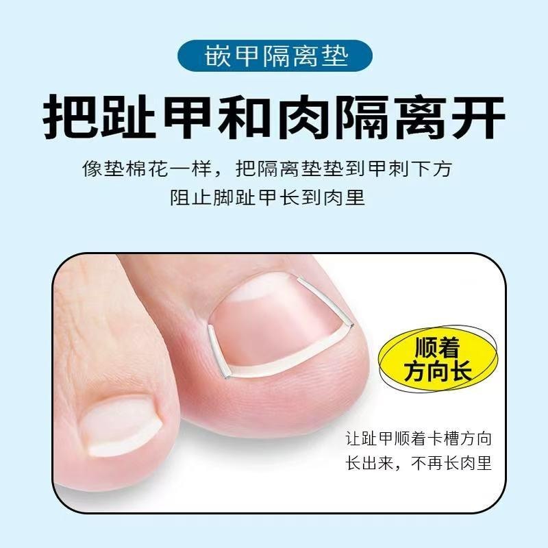爱神严选 甲沟矫正器一套【嵌甲贴20贴+垫片20根】 专治甲沟炎嵌甲贴片 脚趾甲往肉里长专用隔离填充垫 正甲工具神器
