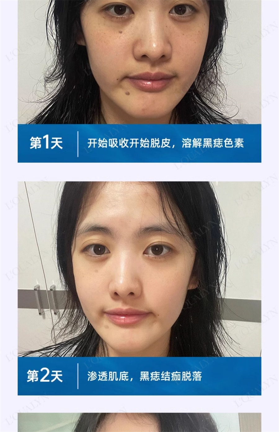 【中国直邮】欧泉琳 点痣膏无痕脸部去痣淡斑神器点痣笔非药水点斑美容专用 5g/瓶+5ml/瓶