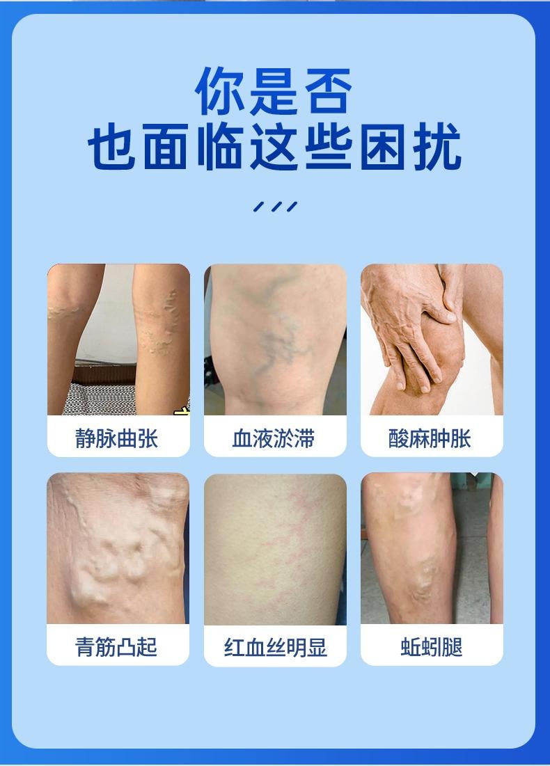【中國直郵】 葵花藥業 醫用退燒凝膠 靜脈曲張 青筋凸起蚯蚓腿專用特效藥膏 20g/支