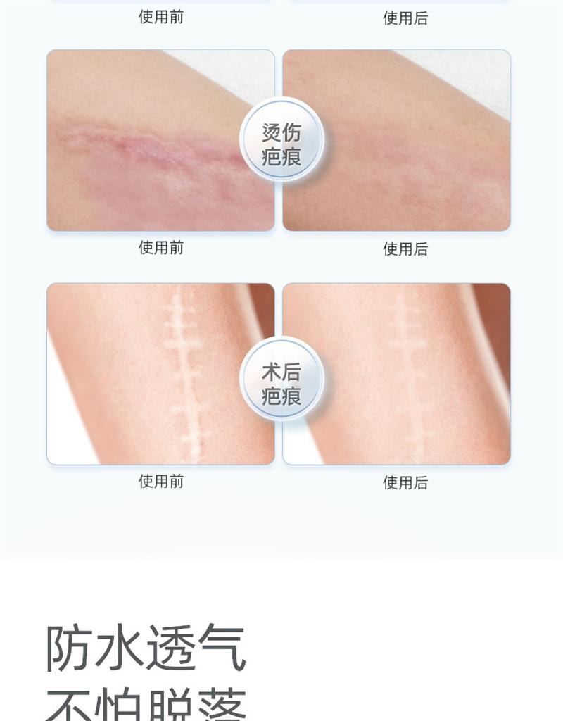 【中國直郵】 舒奈美 矽凝膠疤痕敷料修護貼矽酮傷疤痘印遮瑕貼膚色防水透氣 3片裝/盒