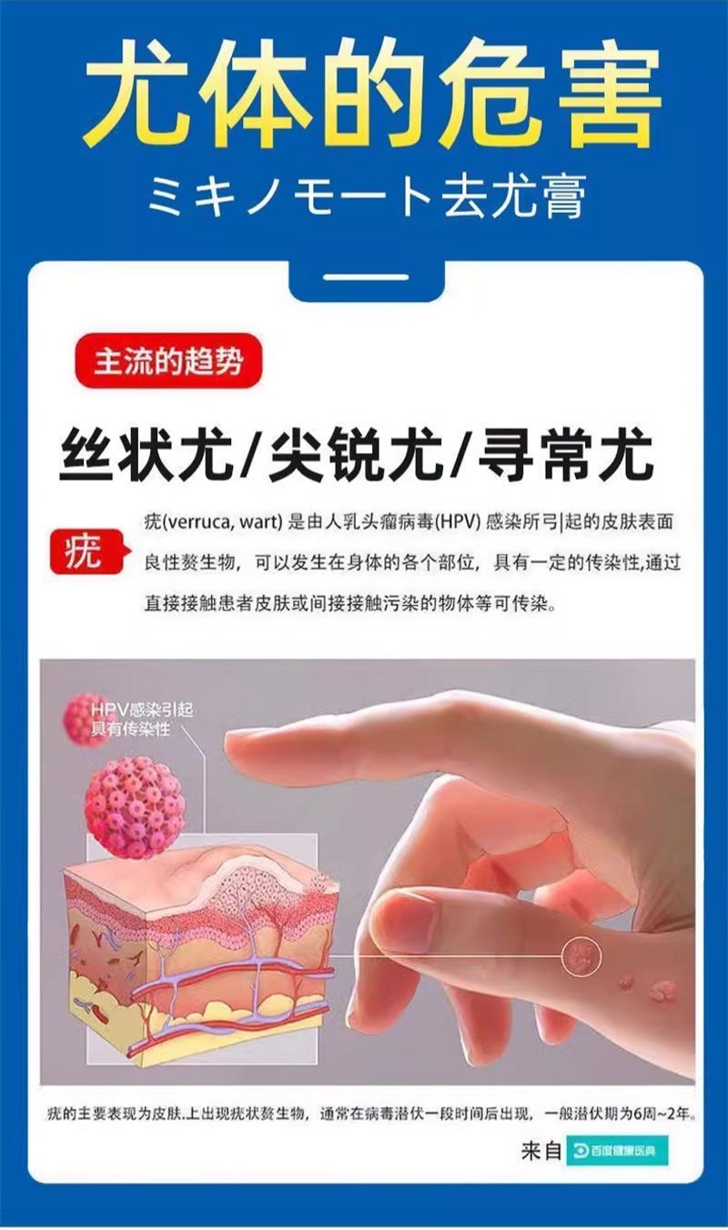 祥医堂 鬼臼毒素酊10ml/盒 去鸡眼尖锐丝状扁平克疣抑菌外用