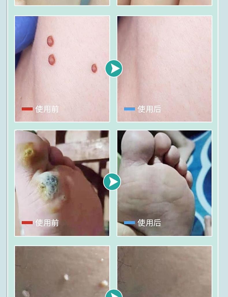 【中国直邮】 祥医堂 疣清宁 扁平尤乳膏 去尤瘊小肉粒神器疣膏 轻松应对各种疣痕问题 20g/盒