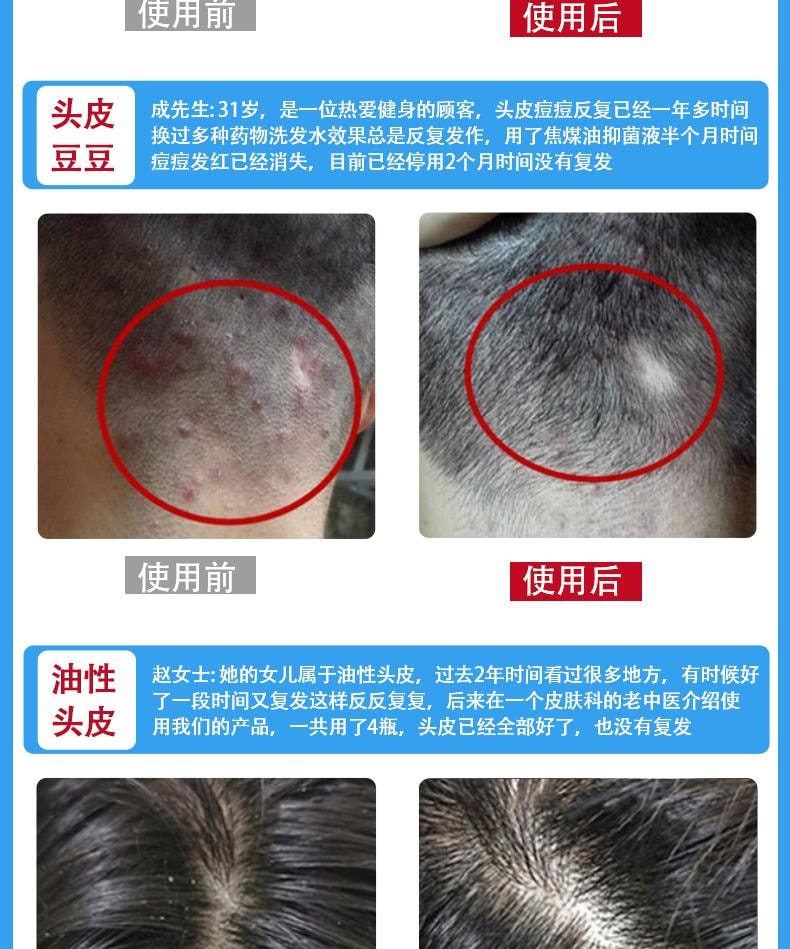 【中国直邮】 祥医堂 苦参碱洗发水 含碱pca锌洗发水 洗头去屑止痒苦渗减正品 110ml/盒