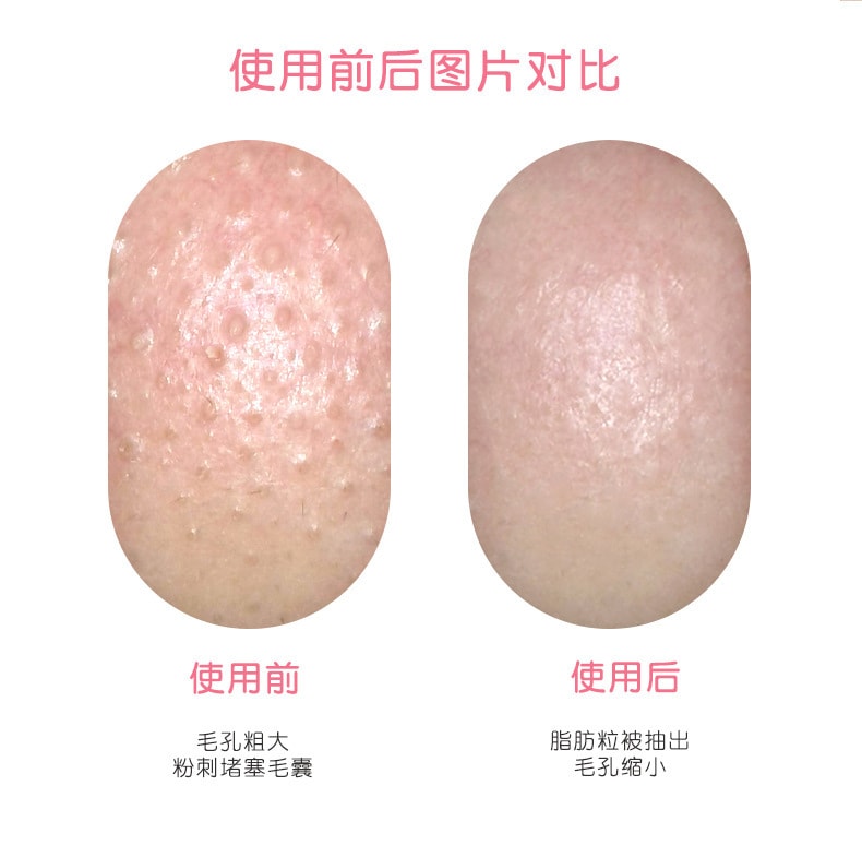 【中国直邮】北欧欧慕 可视化黑头洁面仪电动毛孔清洁器 白色款