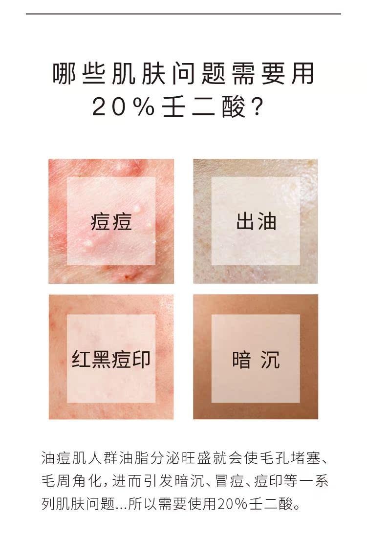 【中國直郵】 John Jeff 20%壬二酸霜15g 快速祛痘 卓效控油